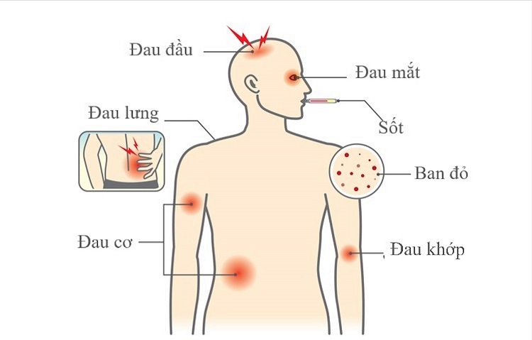 Mất nước là một trong các biến chứng do sốt xuất huyết gây ra